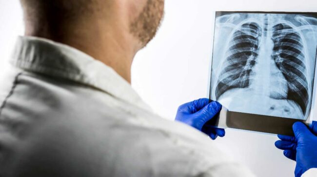 Más de 23000 muertes por cáncer de pulmón | Naberco Digital Más de 23.000 muertes por cáncer de pulmón